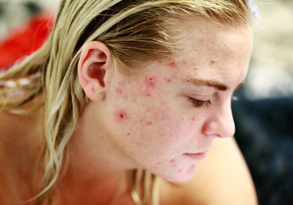 what is acne and how to treat acne